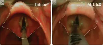Glottic visibility for laryngeal surgery: Tritube® vs. microlaryngeal tube