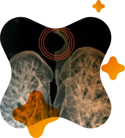 Ultrathin Tritube allowed safe intubation and ventilation in extremely narrow airway.